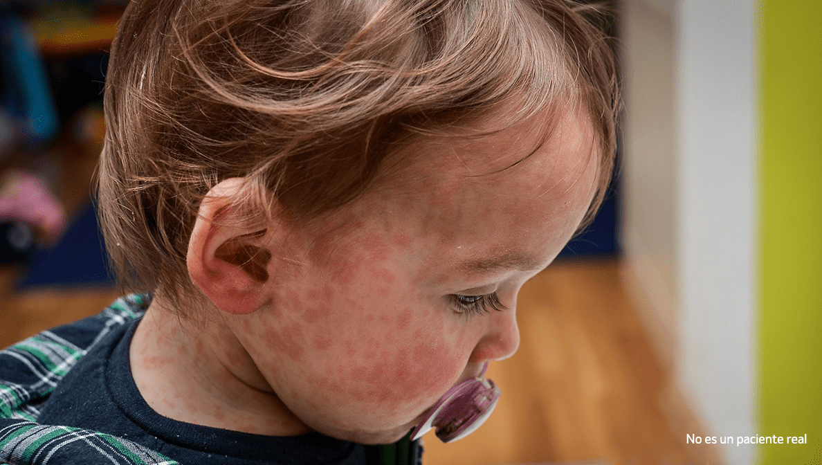 Little girl with measles