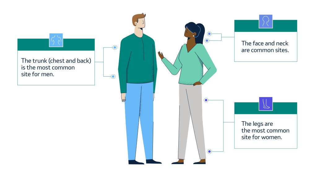 mt-2 Illustration of a man and woman and the most common locations of melanoma