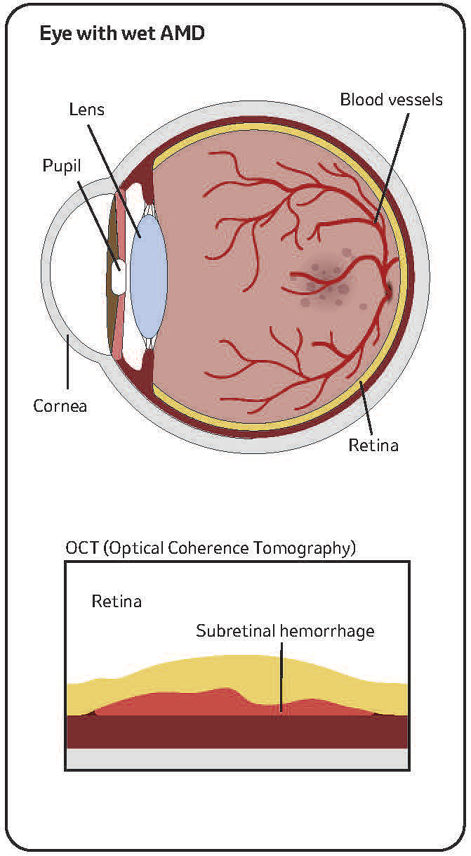 Illustration of eye with wet AMD