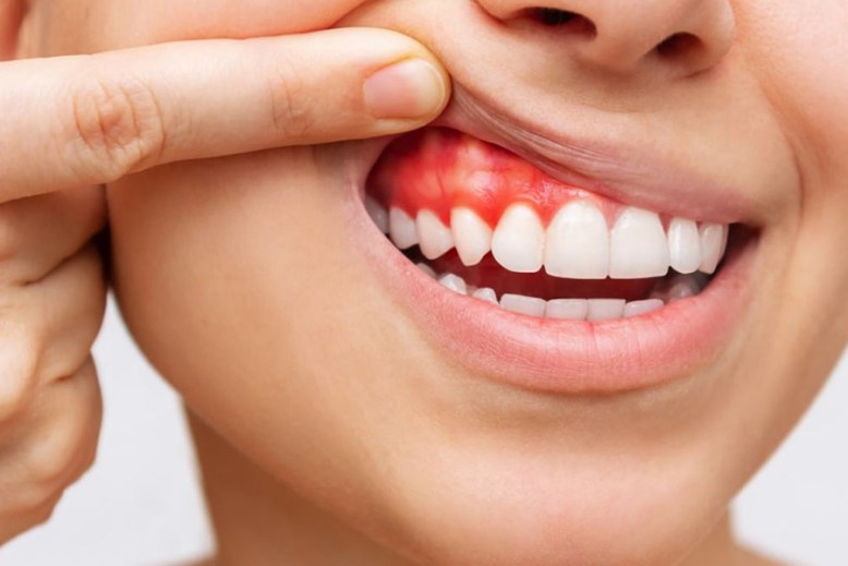 Cáncer de cavidad oral y orofaringe